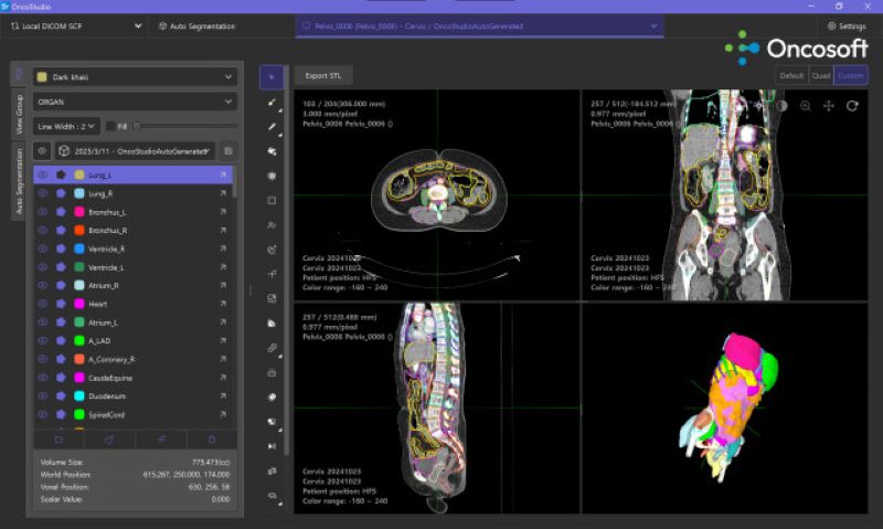 온코소프트의 AI 기반 자동 컨투어링 소프트웨어 ‘온코스튜디오 2.0’